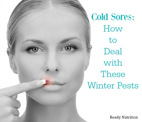 Cold Sores: How to Deal with These Winter Pests