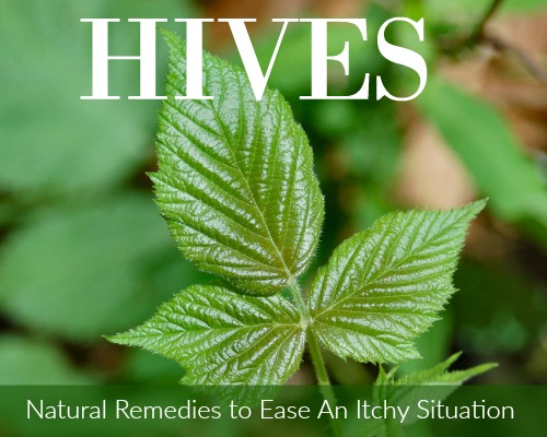 Hives: Natural Remedies to Ease An Itchy Situation