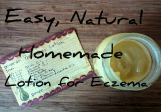 Easy-Homemade-Lotion-for-Eczema-300x198