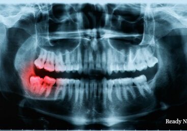 post collapse oral health